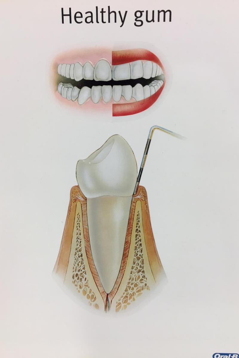 gevinst Isolere hvordan man bruger Har du tandkødsbetændelse, løse tænder, parodontose?