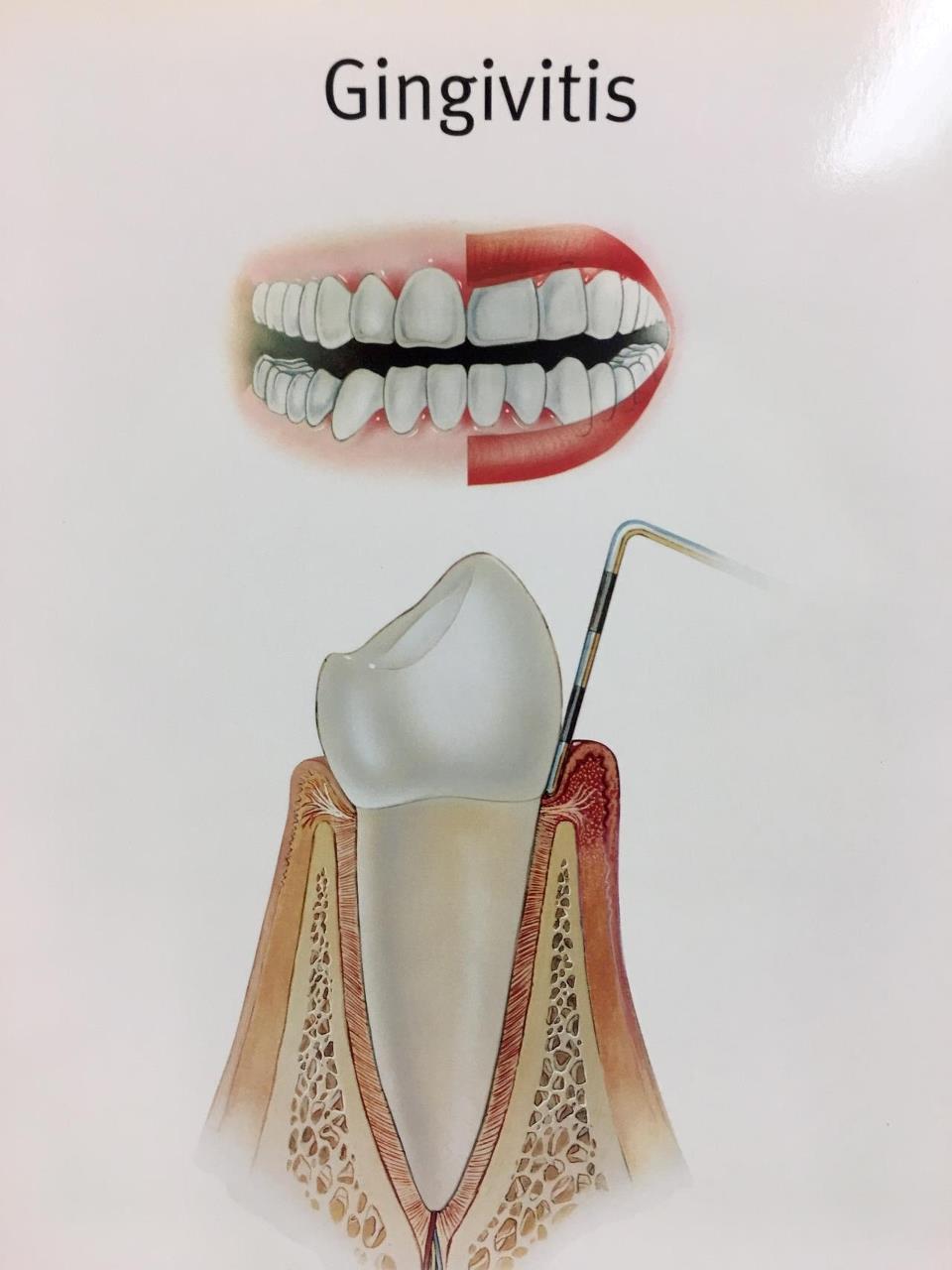 Figur2 – Let parodontose